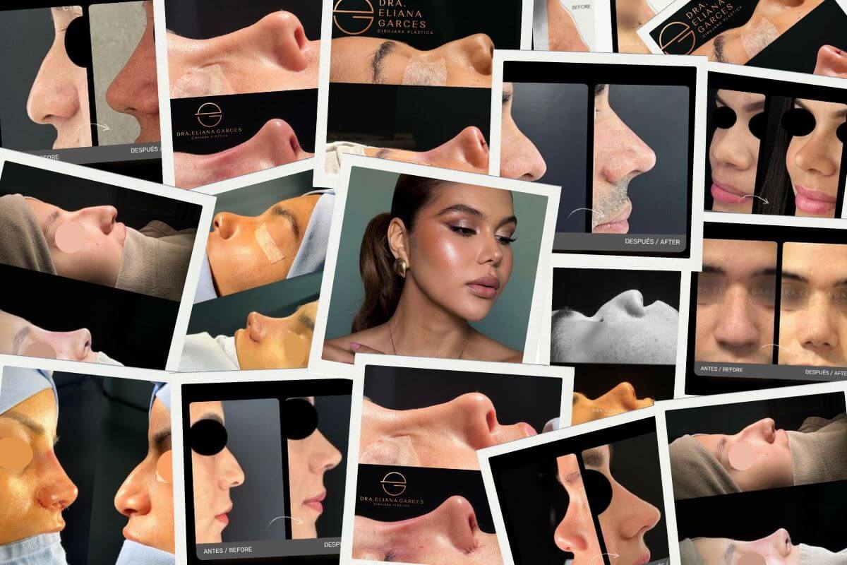 Rinoplastia en Barranquilla con la Dra. Eliana Garcés