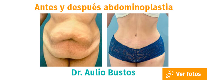 Lipoescultura o liposucción – Cirugía Estética Medellín Colombia