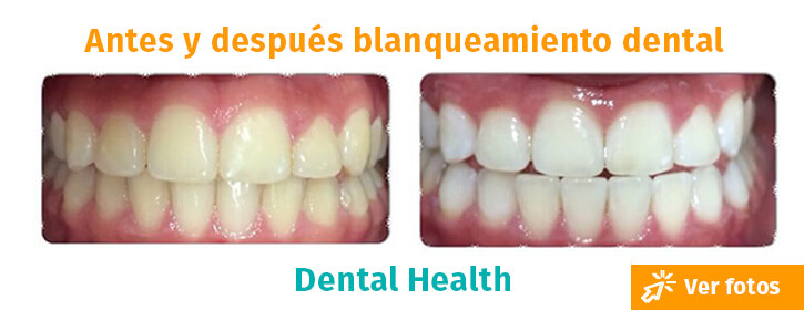 blanqueamiento dental colombia