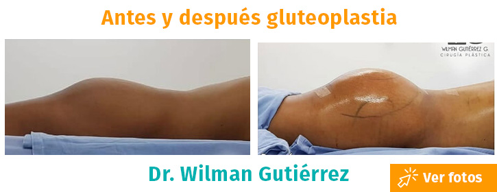 gluteoplastia de aumento colombia