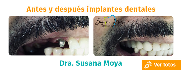 implantes dentales colombia