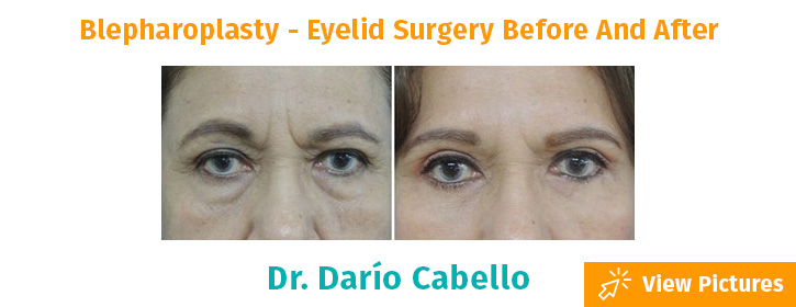 Eyelid Surgery Blepharoplasty for Scottsdale  Phoenix AZ  Dr Todd  Hobgood