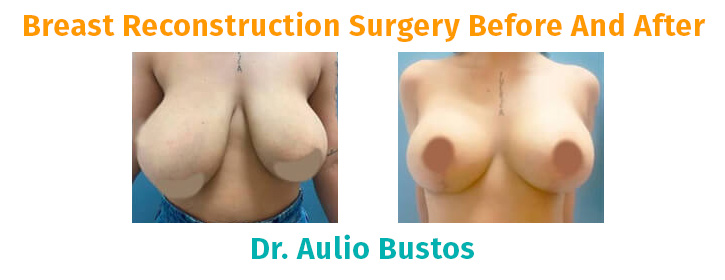 breast reconstruction colombia