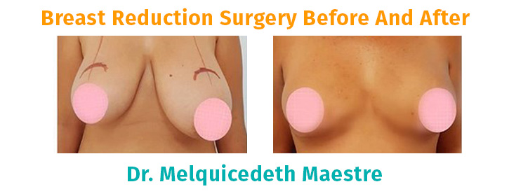 breast reduction colombia