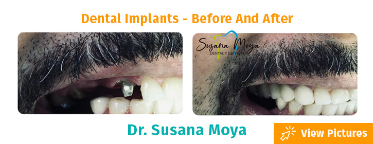dental implants colombia