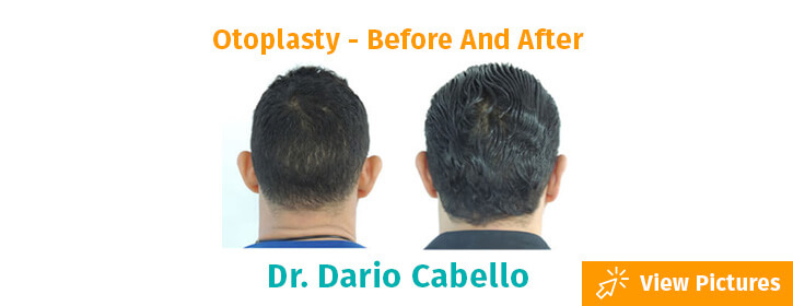 otoplasty  colombia