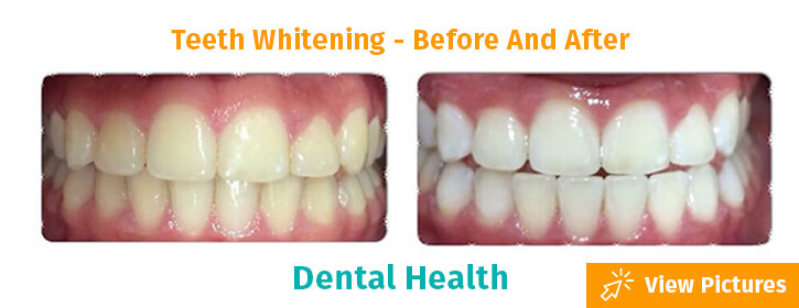 teeth whitening Colombia