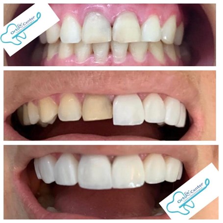 antes y después diseño de sonrisa carillas dentales de ortocenter