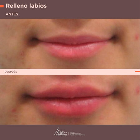 Before and after Lip augmentation - Iván Diazgranados Fernandez