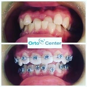 ortodoncia en barranquilla antes y despues