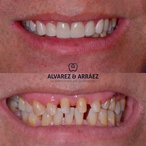 Corona dental