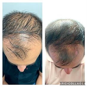 antes y despues alopecia colombia