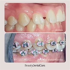 ortodoncia en barranquilla antes y despues