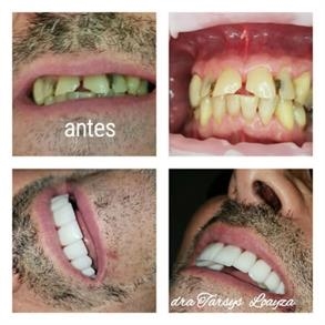 Antes y después limpieza dental de Odent 10 Dr. Carlos Barbosa Correa