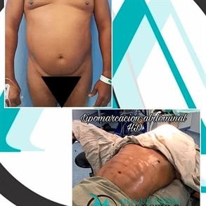 Antes y después marcacion abdominal en hombres en Colombia