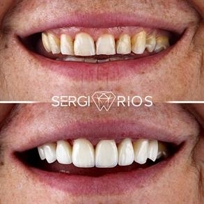 Implantes dentales envigado Colombia