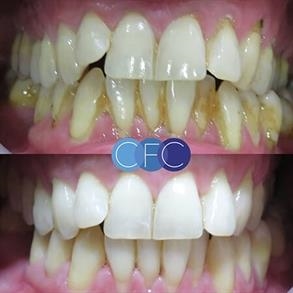 Antes y después limpieza dental de Odent 10 Dr. Carlos Barbosa Correa