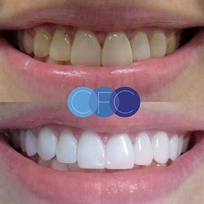 Teeth whitening in colombia