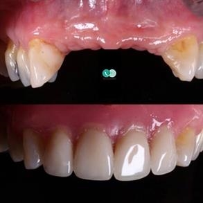 implantes dentales Colombia