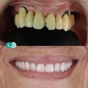 Dental implants in colombia