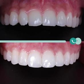Before and after Smile design, Dental implants - Odent 10 Dr. Carlos  Barbosa Correa