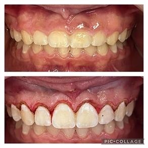 Gingivectomia
