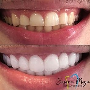 Before and after Smile design, Dental implants - Odent 10 Dr. Carlos  Barbosa Correa