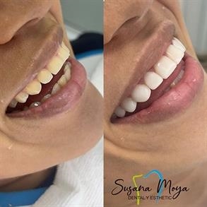 Before and after Smile design, Dental implants - Odent 10 Dr. Carlos  Barbosa Correa