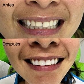 Before and after Smile design, Dental implants - Odent 10 Dr. Carlos  Barbosa Correa