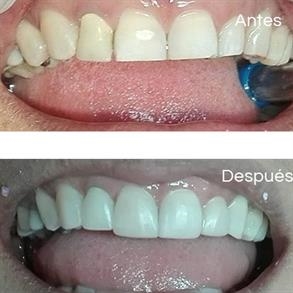 Before and after Smile design, Dental implants - Odent 10 Dr. Carlos  Barbosa Correa