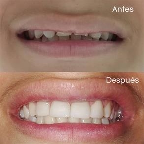 Before and after Smile design, Dental implants - Odent 10 Dr. Carlos  Barbosa Correa