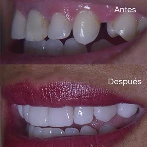 Before and after Smile design, Dental implants - Odent 10 Dr. Carlos  Barbosa Correa