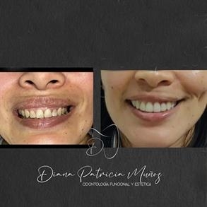 Before and after Smile design, Dental implants - Odent 10 Dr. Carlos  Barbosa Correa