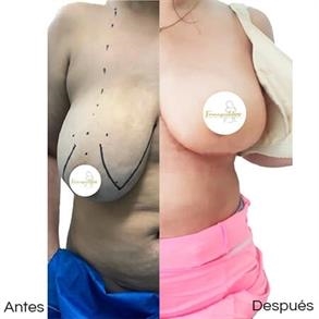 Levantamiento de senos sin implantes