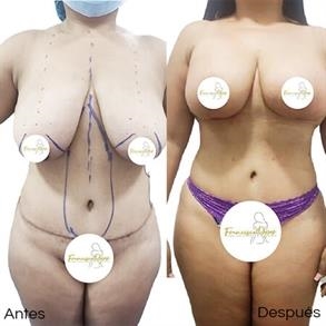 Levantamiento de senos sin implantes