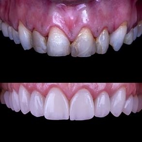 Before and after Smile design, Dental implants - Odent 10 Dr. Carlos  Barbosa Correa