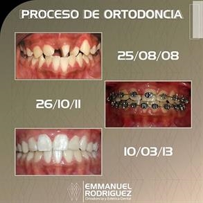 Before and After - Rodriguez Orthodontics