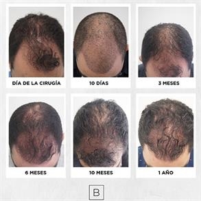 antes y despues alopecia colombia