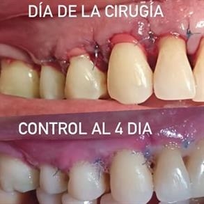 Cirugía periodontal
