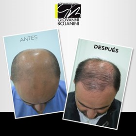 Tratamiento para alopecia colombia