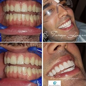 perfecta teeth whitening