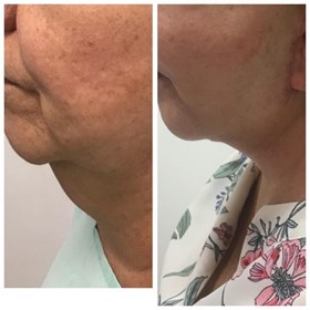 Non Surgical Jowls Treatment colombia