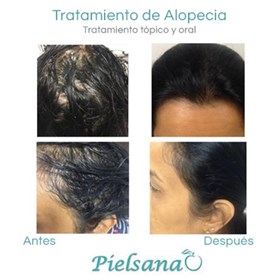 Tratamiento de alopecia