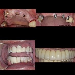 Before and after Smile design, Dental implants - Odent 10 Dr. Carlos  Barbosa Correa